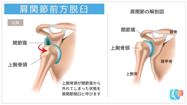 肩関節前方脱臼の模式図（関節窩から上腕骨頭が前方へ外れる状態）
