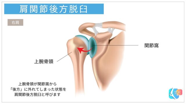 肩関節後方脱臼の模式図（上腕骨頭が関節窩の後方へ外れている状態）