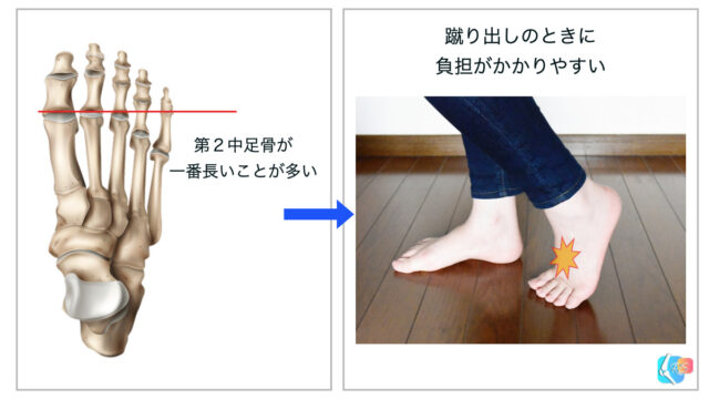 第２中足骨　負荷