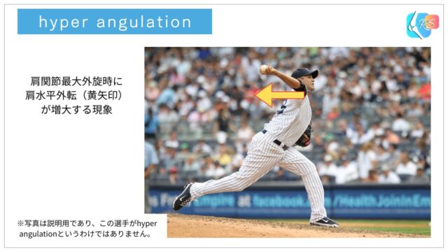 投球動作の肩最大外旋付近で肩水平外転が過度に大きくなるhyper angulationのフォームを示した図