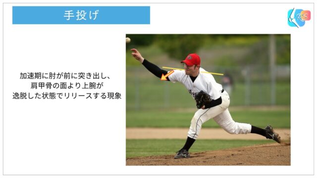 投球動作の加速期で肘が前に突き出る手投げフォーム（肩水平内転の増大）を示した図