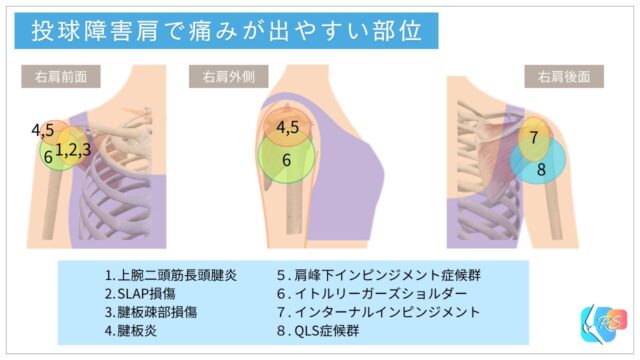 投球障害肩で痛みが出やすい部位と代表的な疾患を示した説明イラスト