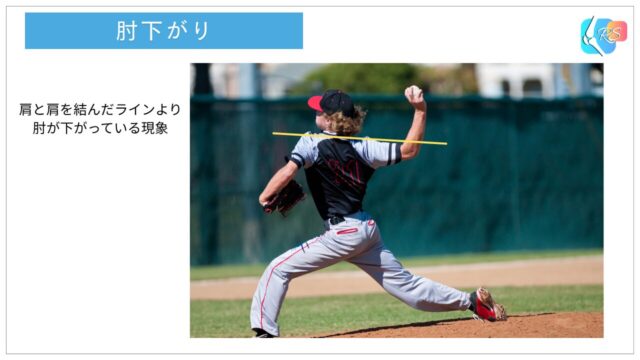 投球動作のレイトコッキング期における肘下がり（肩のラインより肘が低いフォーム）を示した図
