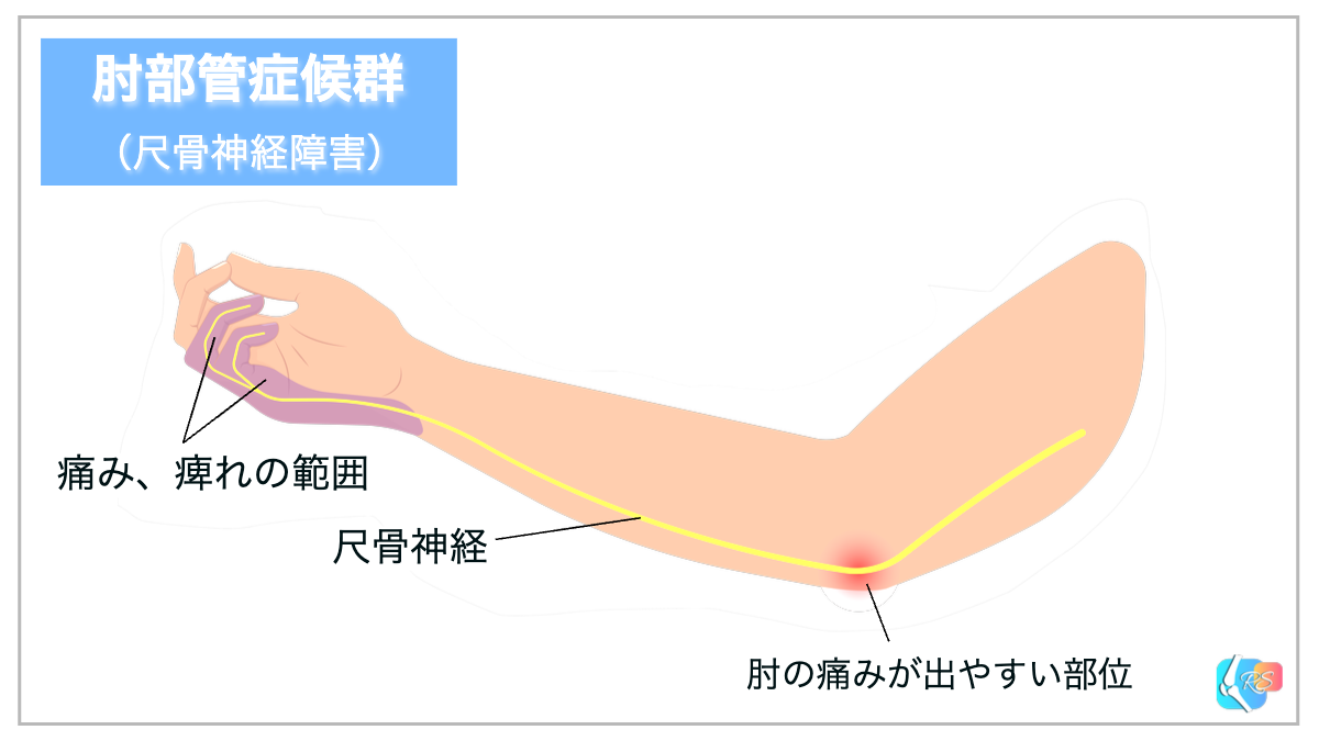 スタージ・ウェーバー症候群