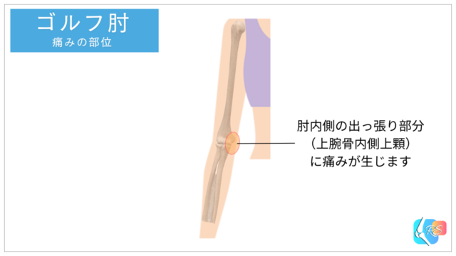 ゴルフ肘（上腕骨内側上顆炎）の痛みの部位｜肘内側の出っ張りに生じる痛み