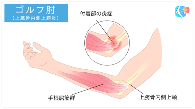ゴルフ肘（上腕骨内側上顆炎）のイメージ図｜手根屈筋群と回内筋群の付着部に負荷がかかる様子