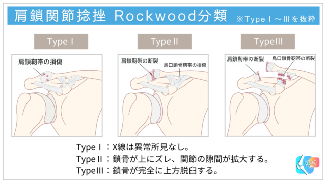 肩鎖関節捻挫のRockwood分類タイプⅠ〜Ⅲを示した図。靭帯損傷の程度と鎖骨の位置変化を比較したイラスト
