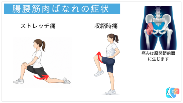 腸腰筋肉ばなれ・腸腰筋腱周囲炎でみられる股関節伸展時痛と股関節屈曲時痛