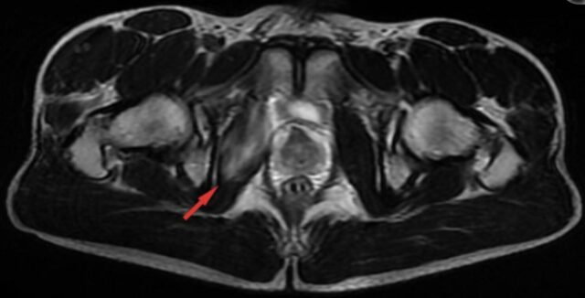 内閉鎖筋肉ばなれ mri
