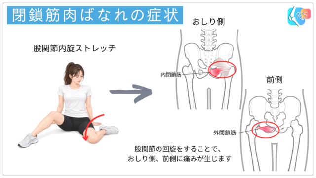 閉鎖筋肉ばなれでみられる股関節内旋時と外旋抵抗時の深部痛
