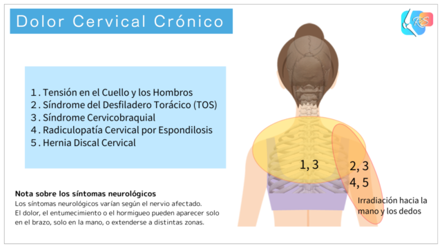 Dolor cervical crónico causado por tensión muscular y sobrecarga postural