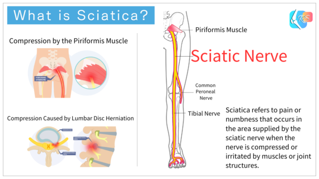 What is Sciatica?

Compression by the Piriformis Muscle

Compression Caused by Lumbar Disc Herniation

Sciatic Nerve

Piriformis Muscle

Common Peroneal Nerve