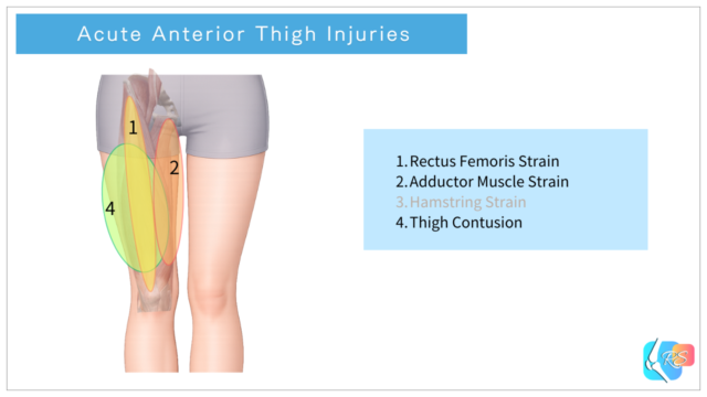 Acute anterior thigh injuries including rectus femoris strain, adductor strain, hamstring strain, and thigh contusion