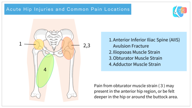 Diagram showing acute hip injuries and their common pain locations