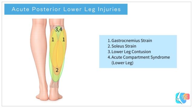 Acute posterior lower leg injuries including gastrocnemius strain, soleus strain, lower leg contusion, and acute compartment syndrome