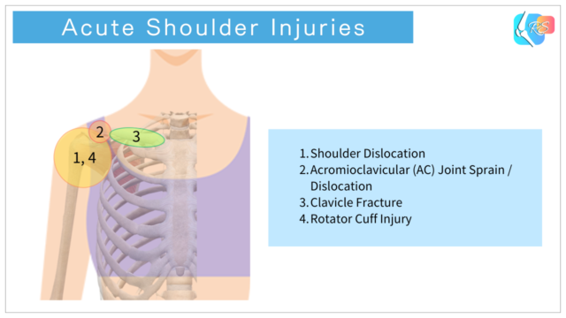 Anterior view illustration showing common acute shoulder injuries, including dislocation, AC joint injury, clavicle fracture, and rotator cuff injury