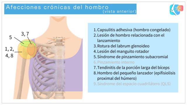 Ilustración en vista anterior que muestra afecciones crónicas comunes del hombro, como la capsulitis adhesiva, las lesiones del manguito rotador y los síndromes de pinzamiento