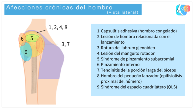 Ilustración en vista lateral que muestra afecciones crónicas comunes del hombro, como los síndromes de pinzamiento y las lesiones del manguito rotador