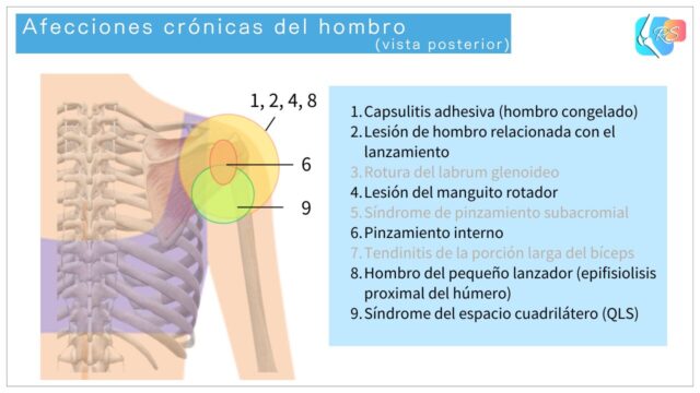 Ilustración en vista posterior que muestra afecciones crónicas comunes del hombro, incluyendo lesiones del manguito rotador, pinzamiento interno y alteraciones neurológicas