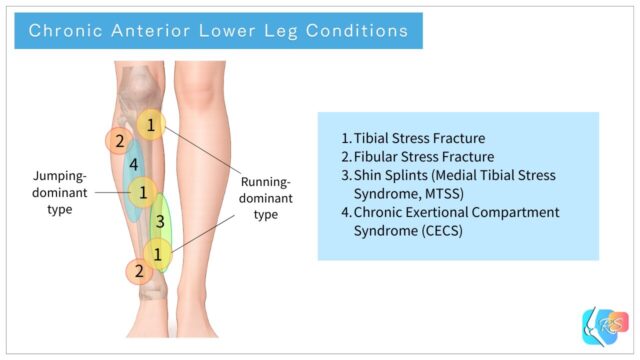 Chronic anterior lower leg conditions including tibial stress fracture, fibular stress fracture, shin splints (medial tibial stress syndrome), and chronic exertional compartment syndrome