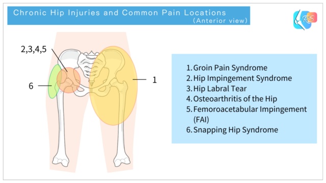 Diagram showing chronic hip injuries and common pain locations, anterior view