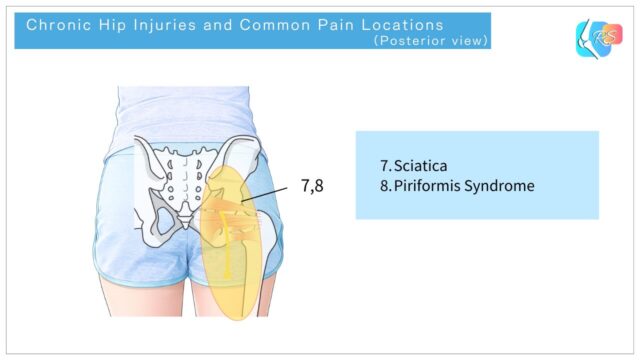 Diagram showing chronic hip injuries and common pain locations, posterior view