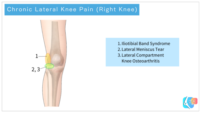 Illustration showing common causes of chronic lateral knee pain and typical pain locations