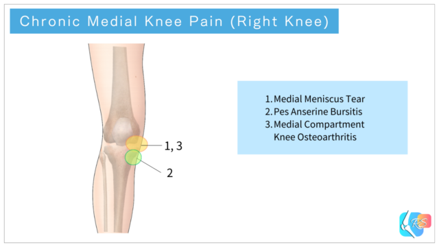 Illustration showing common causes of chronic medial knee pain and typical pain locations