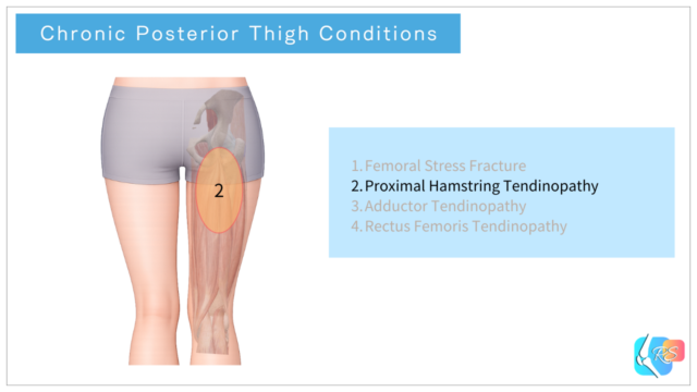 Chronic posterior thigh conditions including proximal hamstring tendinopathy, hamstring-related pain, and overuse injuries of the posterior thigh