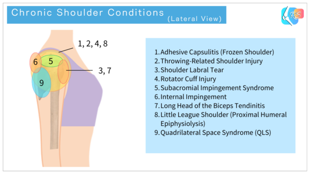 Lateral view illustration showing common chronic shoulder conditions, including impingement syndromes and rotator cuff disorders