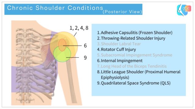 Posterior view illustration showing common chronic shoulder conditions, including rotator cuff disorders, internal impingement, and nerve-related symptoms