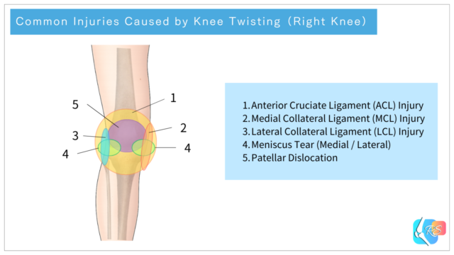 Illustration showing common injuries caused by knee twisting and their typical pain locations