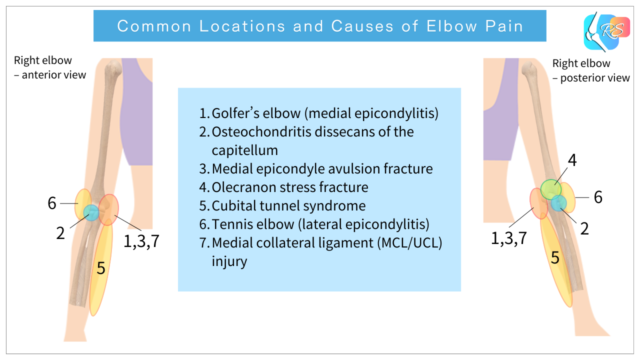 Illustration showing common elbow pain locations and injuries in the right elbow