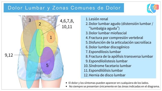 Dolor lumbar y zonas comunes de dolor
