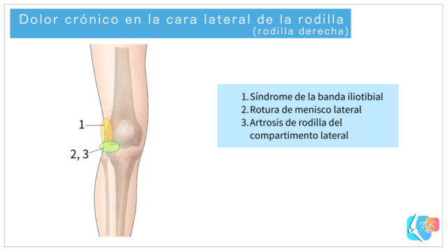 Ilustración que muestra las causas más comunes del dolor crónico en la cara lateral de la rodilla y las zonas típicas de dolor