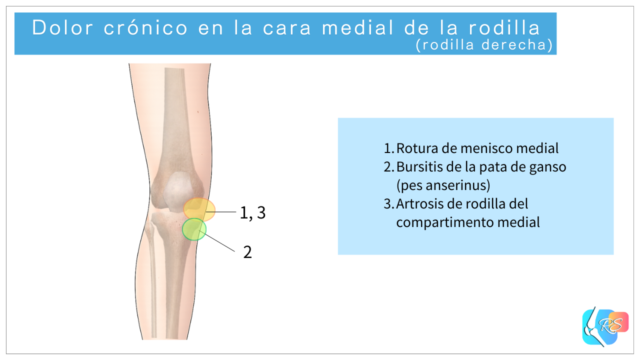 Ilustración que muestra las causas más comunes del dolor crónico en la cara medial de la rodilla y las zonas típicas de dolor