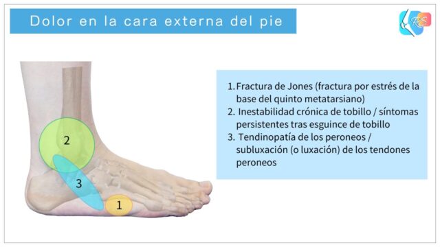 Zonas de dolor en la cara externa del pie