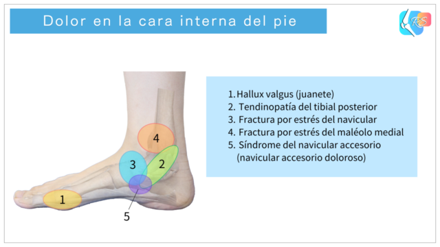 Zonas de dolor en la cara interna del pie