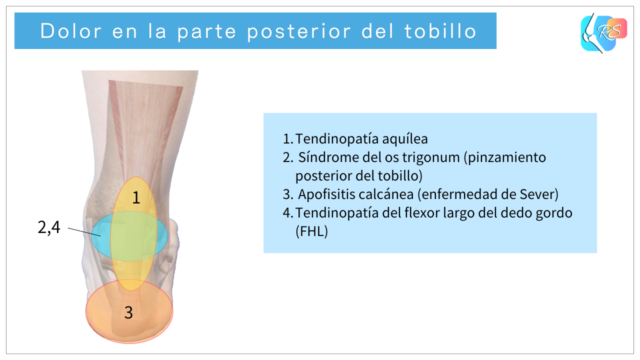 Zonas de dolor en la parte posterior del tobillo