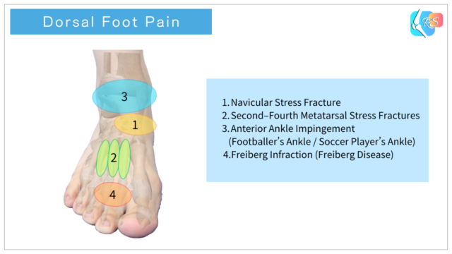 Dorsal foot pain areas diagram