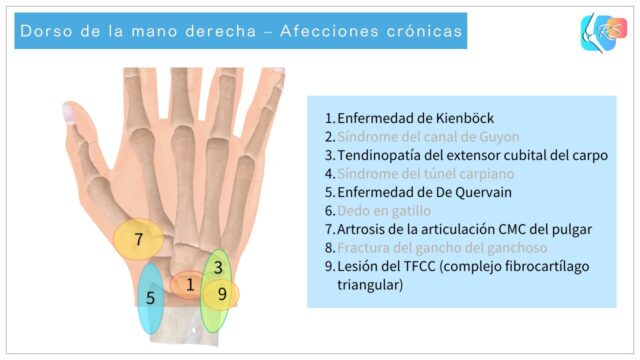 Dorso de la mano derecha que muestra afecciones crónicas comunes de la mano y la muñeca
