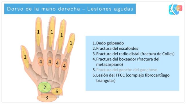 Dorso de la mano derecha que muestra lesiones agudas comunes de la mano, los dedos y la muñeca