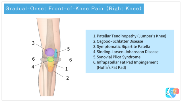 Illustration showing common causes of gradual-onset front-of-knee pain and typical pain locations