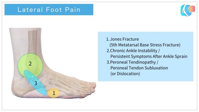 Lateral foot pain areas diagram