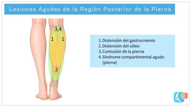 Lesiones agudas de la región posterior de la pierna, incluyendo distensión del gastrocnemio, distensión del sóleo, contusión de la pierna y síndrome compartimental agudo