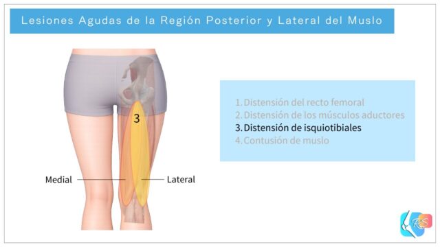 Lesiones agudas de la región posterior y lateral del muslo, incluyendo distensión de isquiotibiales, distensión de aductores, distensión del recto femoral y contusión de muslo