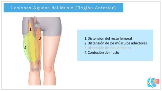 Lesiones agudas de la región anterior del muslo, incluyendo distensión del recto femoral, distensión de aductores, distensión de isquiotibiales y contusión de muslo