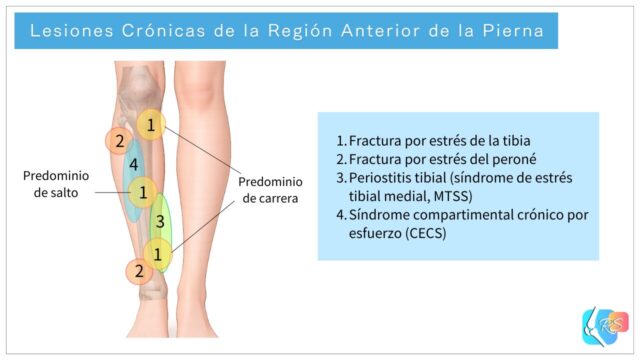 Lesiones crónicas de la región anterior de la pierna, incluyendo fractura por estrés tibial, fractura por estrés del peroné, periostitis tibial (MTSS) y síndrome compartimental crónico por esfuerzo