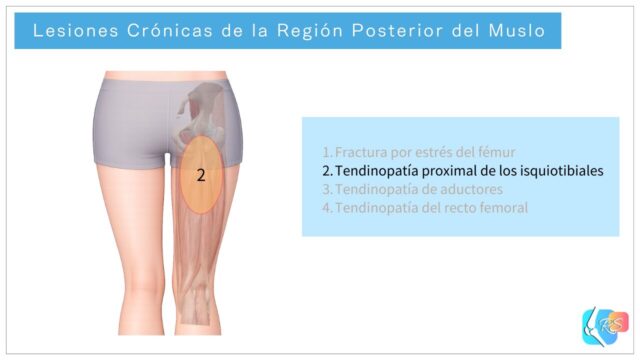 Lesiones crónicas de la región posterior del muslo, incluyendo tendinopatía proximal de los isquiotibiales, fractura por estrés femoral y dolor muscular por sobrecarga