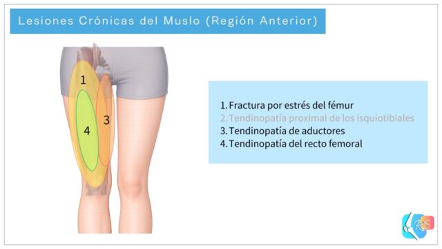 Lesiones crónicas de la región anterior del muslo, incluyendo fractura por estrés del fémur, tendinopatía proximal de los isquiotibiales, tendinopatía de aductores y tendinopatía del recto femoral